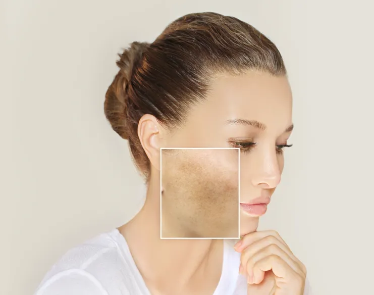 How to Reduce Facial Pigmentation Effectively