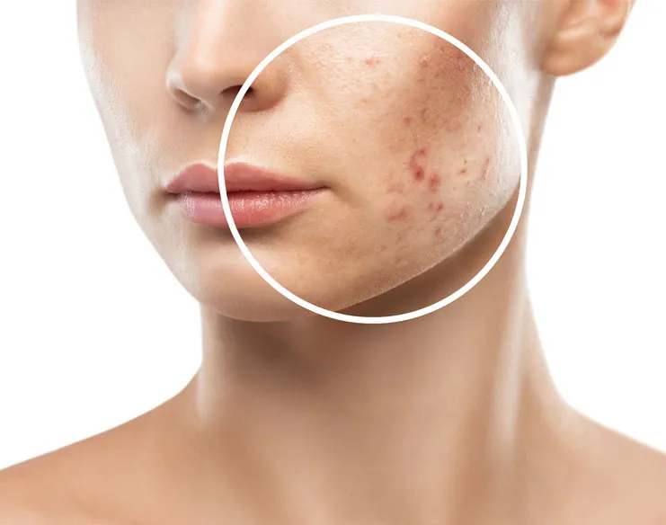 Laser Treatment for Acne Scars: How It Works and What to Expect