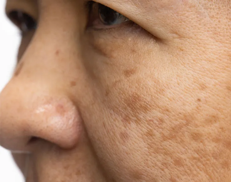 Laser Treatment for Pigmentation: What You Need to Know