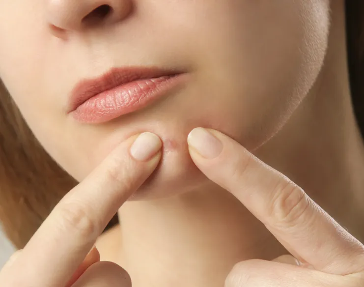 Persistent Chin Acne: Causes & Treatment Options